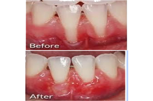 Before and After for Management Of Periodontal Recession